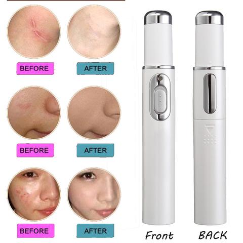 Blue Light Therapy Acne Laser Pen - Wrinkle & Scar Removal Device